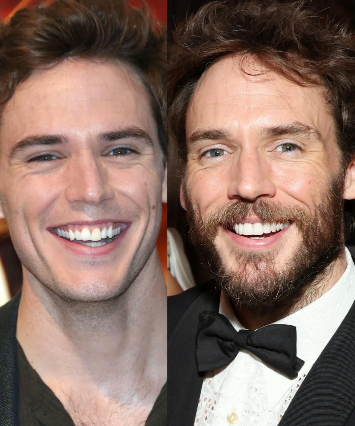 celebrities before and after veneers (6)