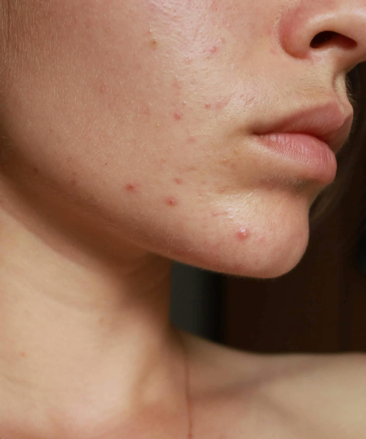 What Your Skin Issues Could Be Telling You About Your Health, According To An Aesthetician