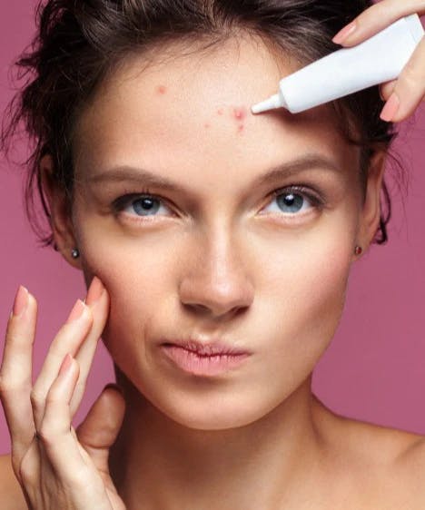 The Real Causes Of Acne That Cosmetic Companies Won't Tell You