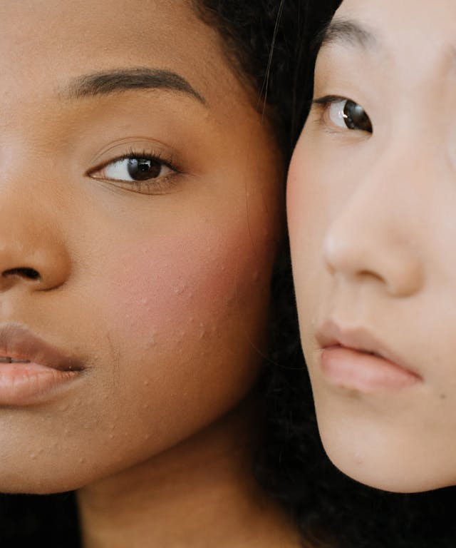 Why Is Adult Acne More Prevalent Now Than Ever Before?